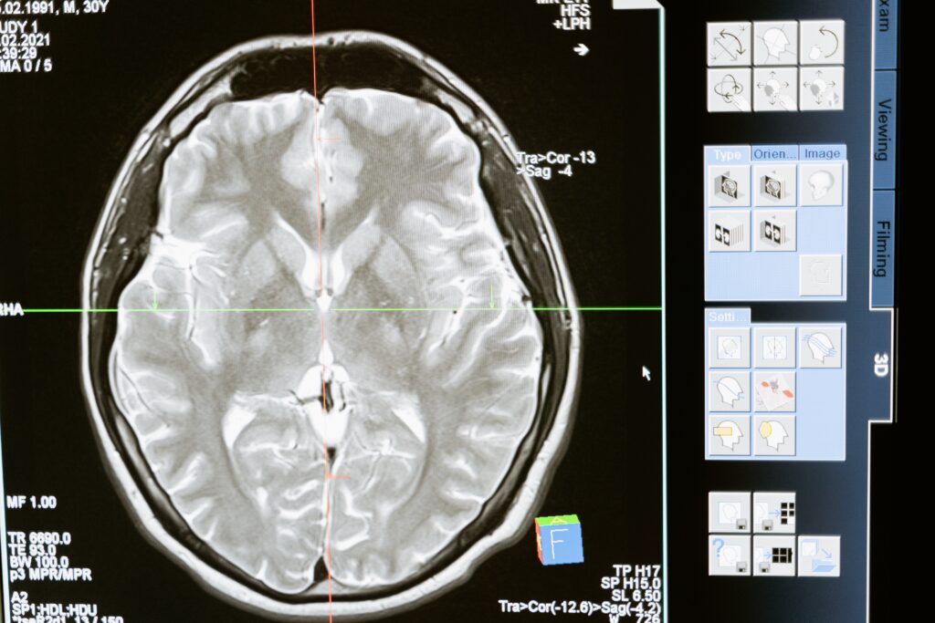 MRI for Seizures